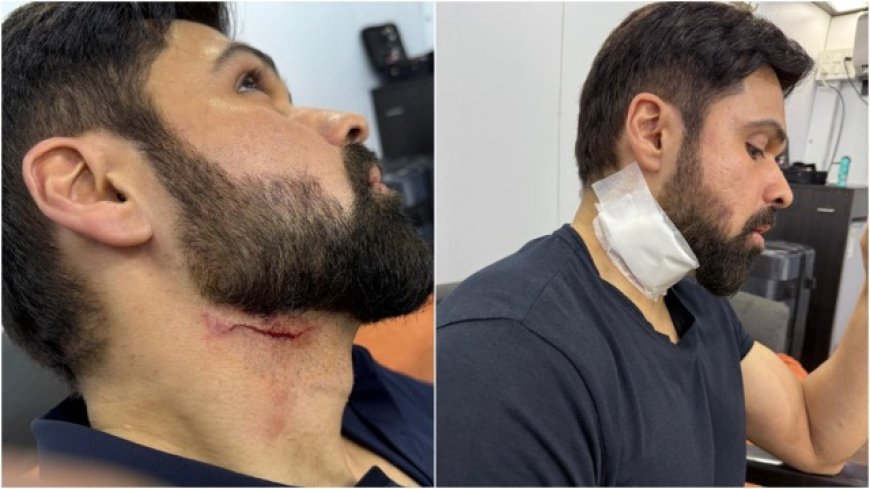 Imran Hashmi Injured on Set: Viral Photos Spark Concern Among Fans